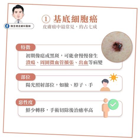 長毛痣|皮膚長痣、長斑是皮膚癌前兆？皮膚癌初期4大症狀快。